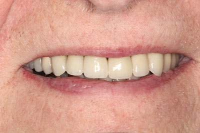 Beautiful straight, white teeth after