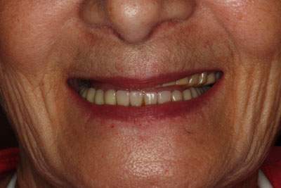 Smile with yellow stains on teeth covered by top lip