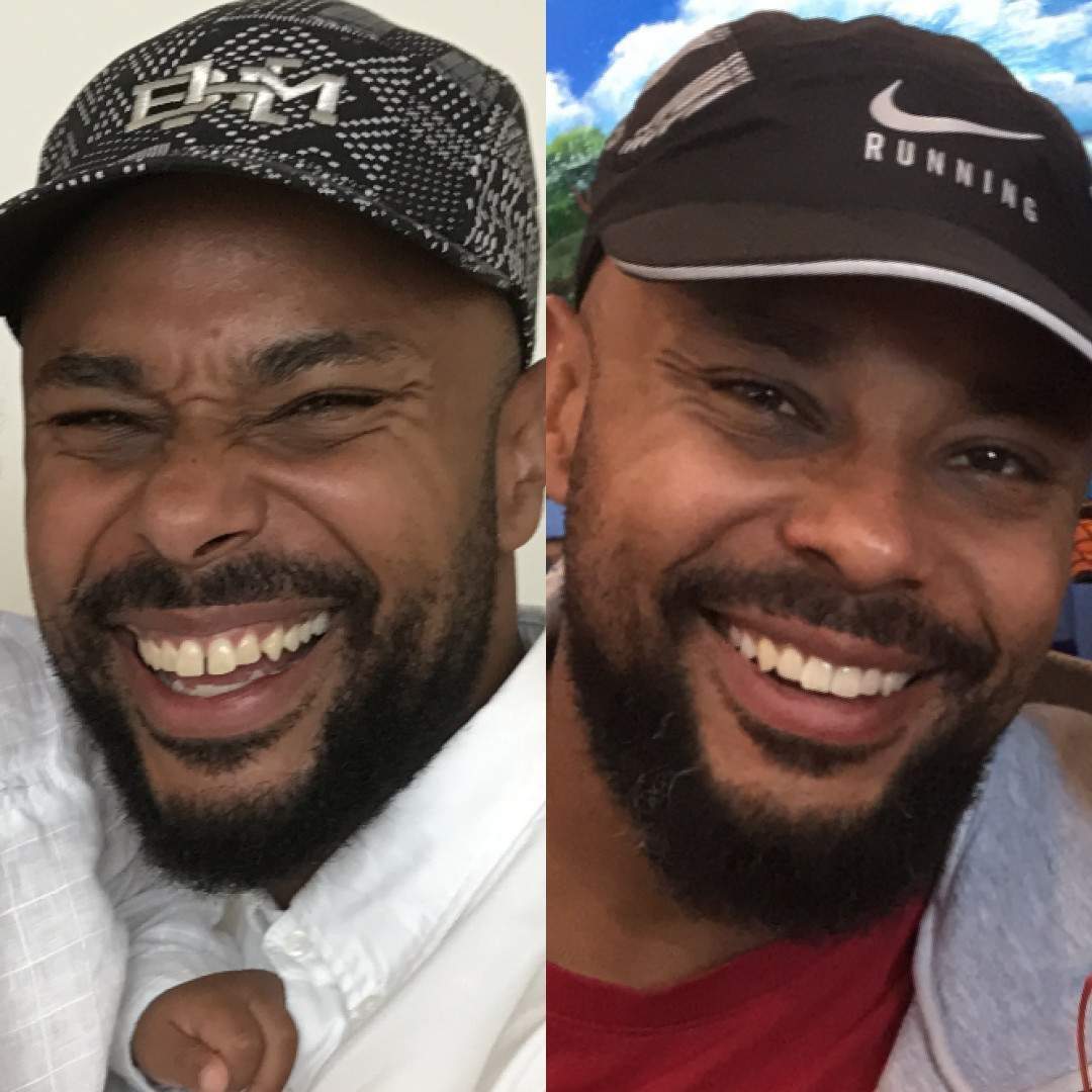 African American male with spaces between teeth before to straight healthy teeth after