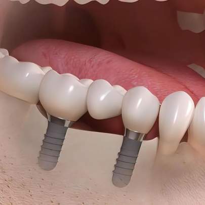 What dental implants looks like under the gum